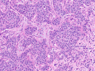 Figure 4. A close up in high resolution from Figure 3; an example from case 11 in this dataset, here showing an area of interest for atypia and mitosis from the preoperative sample (biopsy).